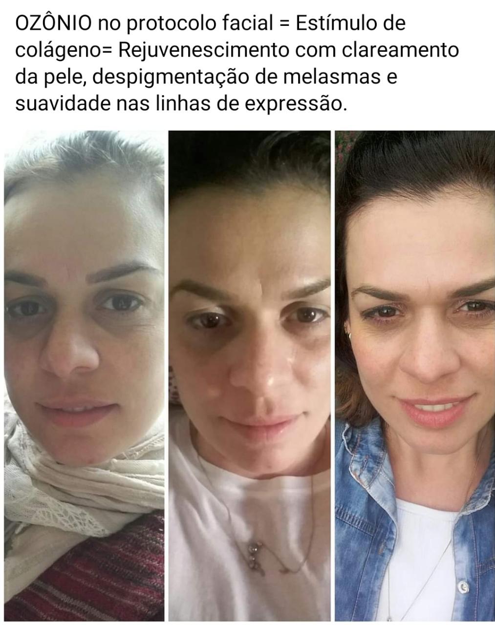 Estética com ozônio - Ozônio Integral