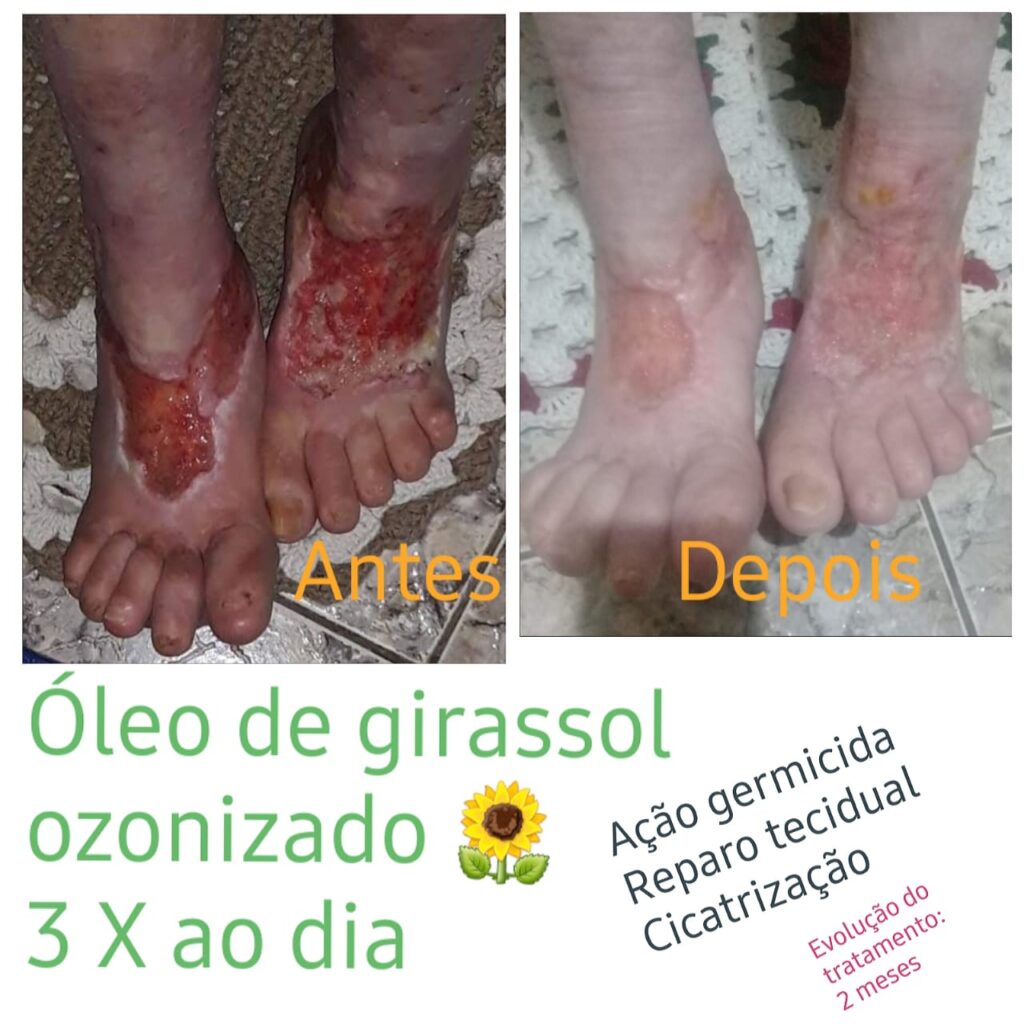 Óleo de girassol ozonizado : Ação germicida, reparo tecidual e cicatrização